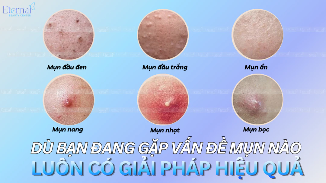Các loại mụn thường gặp và giải pháp điều trị mụn tại Eternal Beauty Center