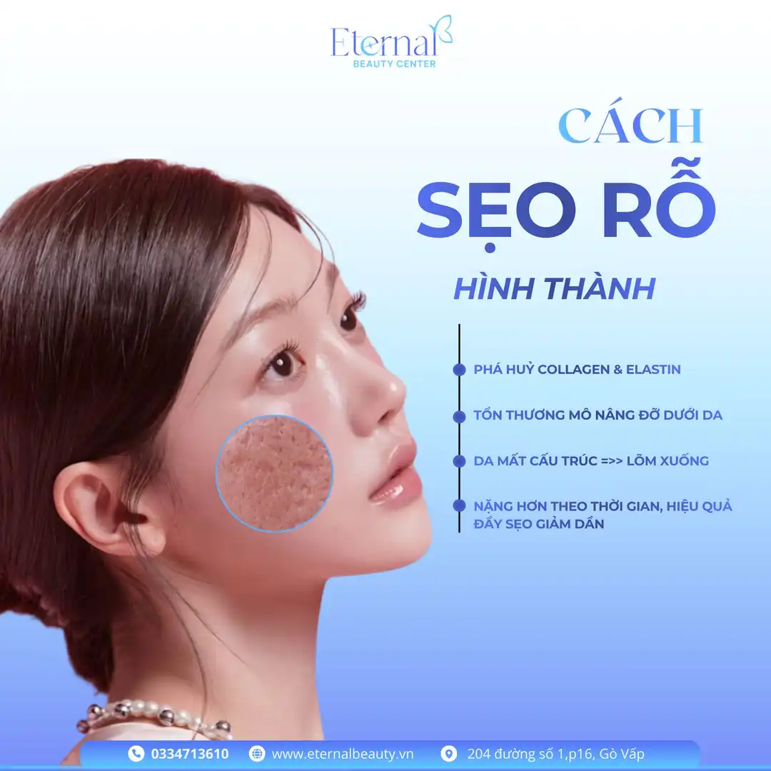 Cơ chế hình thành sẹo rỗ — phá huỷ collagen, elastin và tổn thương mô nâng đỡ dưới da