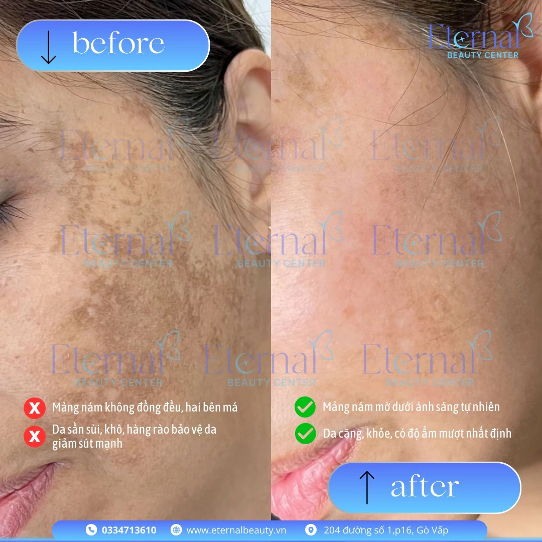 So sánh trước và sau điều trị nám má với phác đồ E-Mela tại Eternal Beauty Center
