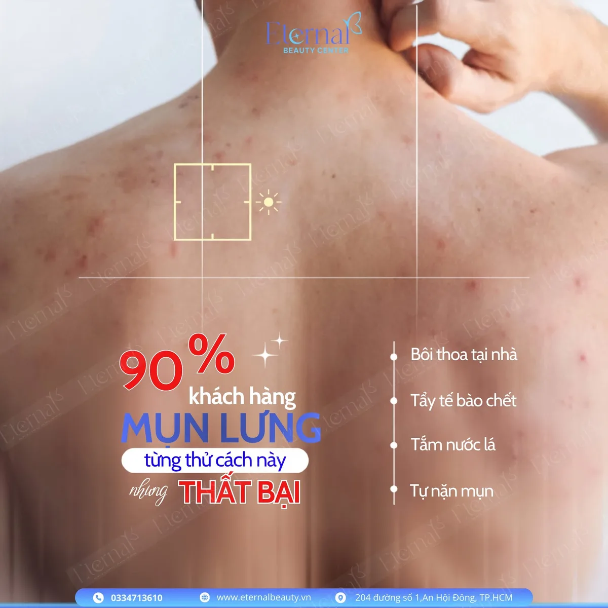 Bốn cách tự xử lý mụn lưng nhiều người đã thử — bôi thoa tại nhà, tẩy tế bào chết, tắm nước lá, tự nặn mụn — mỗi cách phá vỡ một giai đoạn của phác đồ