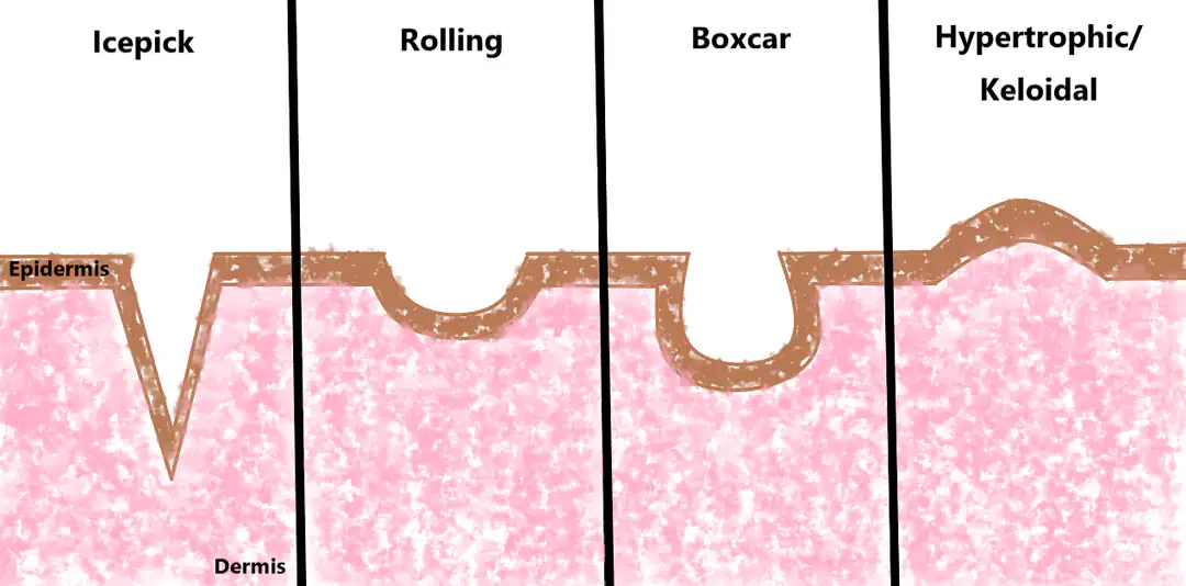 Phân loại 3 loại sẹo rỗ atrophic: ice pick, boxcar, rolling theo hình thái và độ sâu