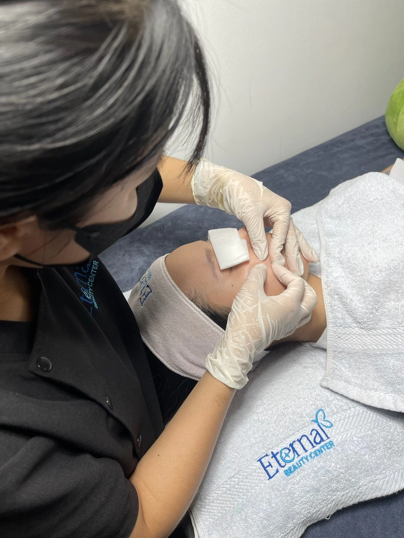Acne extraction with O2 Peel at Eternal Beauty Center: best done about a week before the day, or earlier, so freshly extracted spots have time to settle