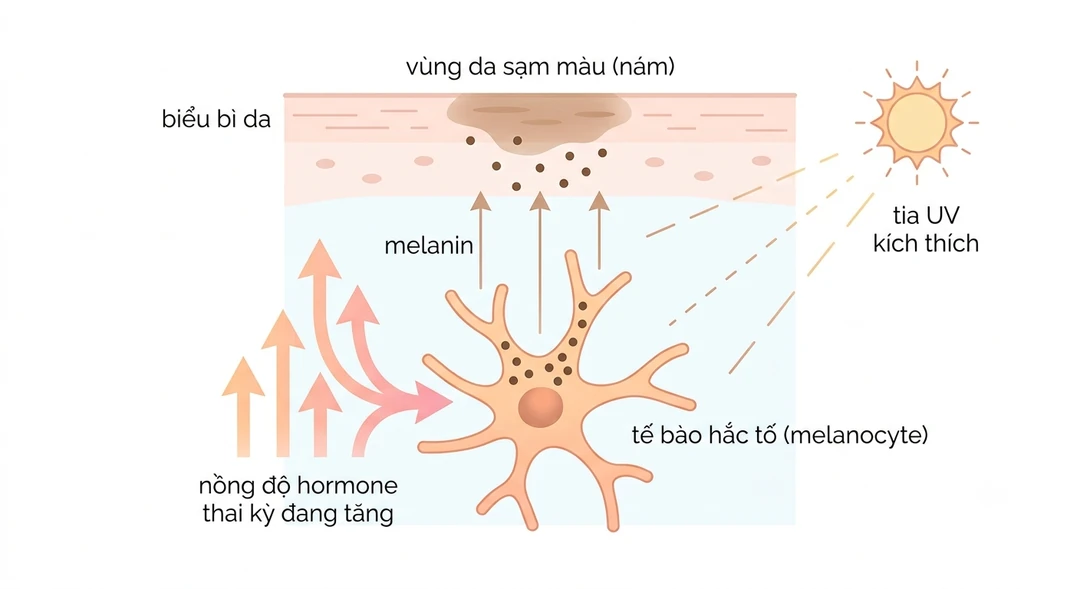 Minh họa cơ chế nám nội tiết: hormone thai kỳ tăng kích thích tế bào sắc tố sản sinh melanin, cộng tác động của ánh nắng