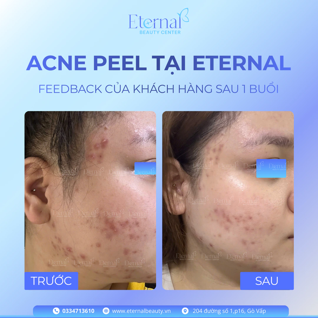 Hình ảnh trước và sau một buổi Acne Peel tại Eternal Beauty Center (kết quả tùy cơ địa mỗi người)