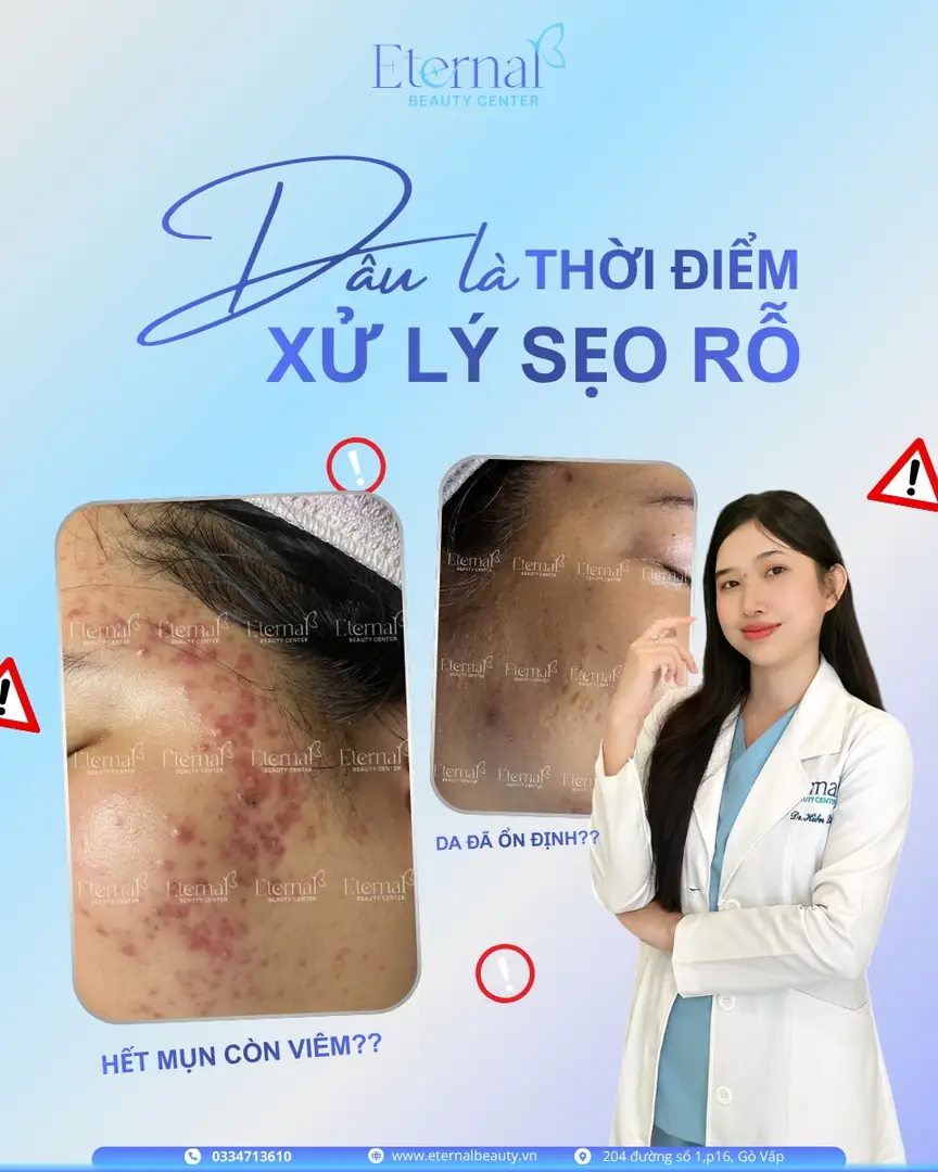 So sánh tình trạng da cần ổn định trước khi xử lý sẹo rỗ