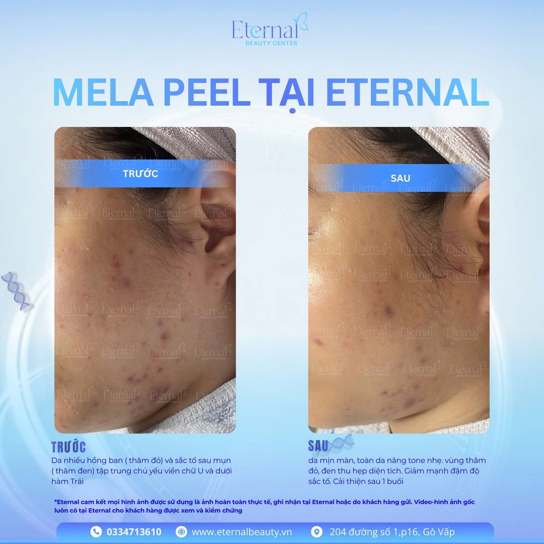 Hình ảnh trước và sau liệu trình Mela Peel tại Eternal Beauty Center – cải thiện thâm sau mụn