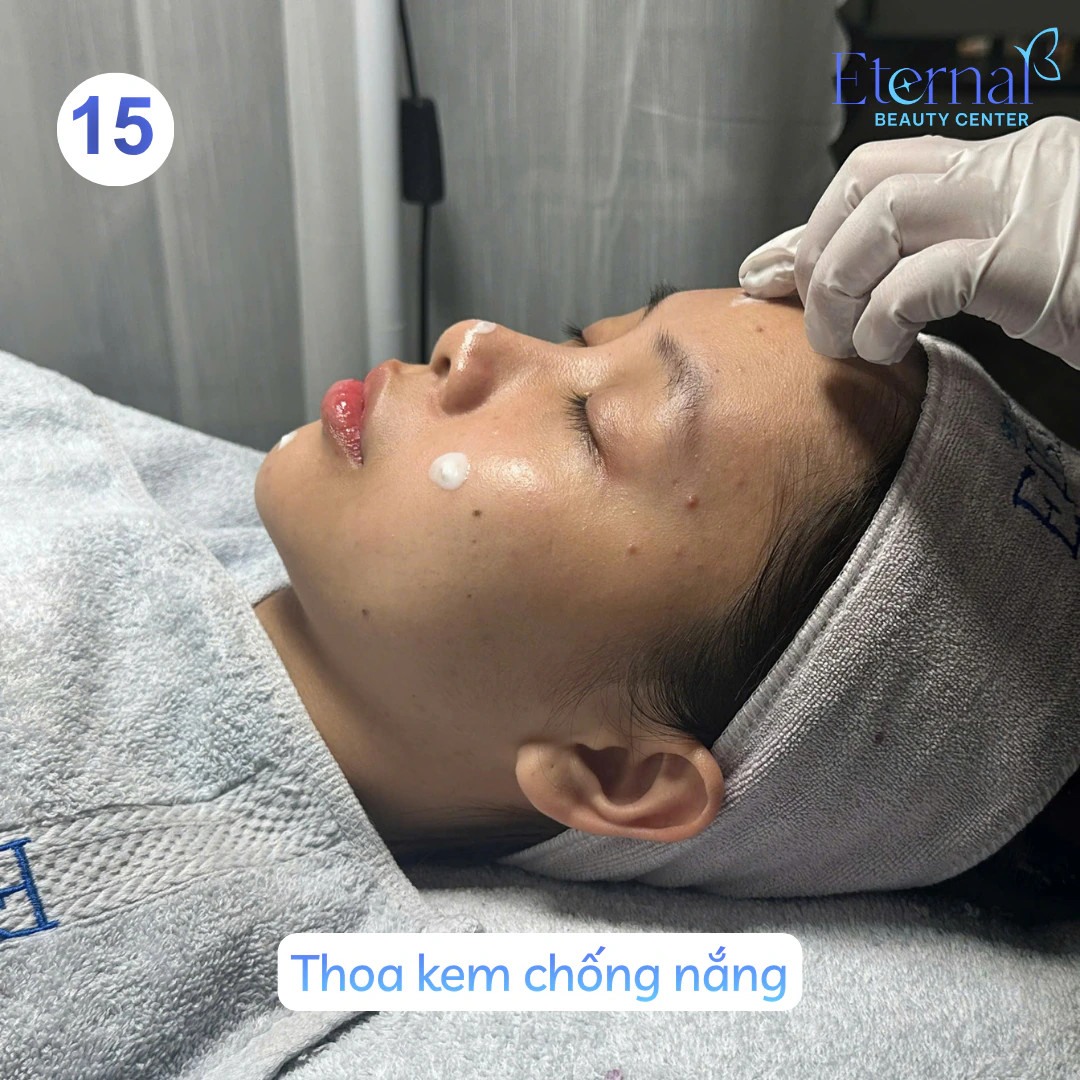 Bước 15 – Chống nắng trong quy trình xử lý nhân mụn chuẩn y khoa tại Eternal