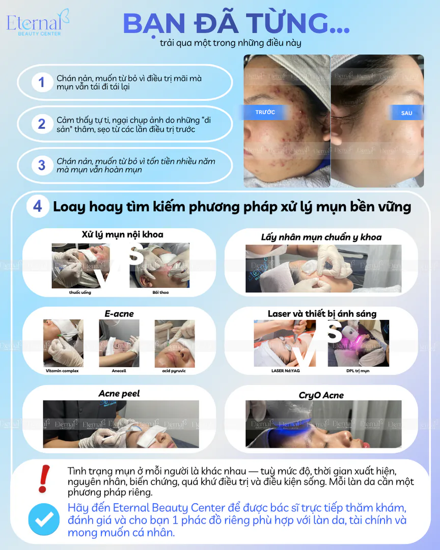Những trải nghiệm thường gặp khi điều trị mụn chưa đúng cách
