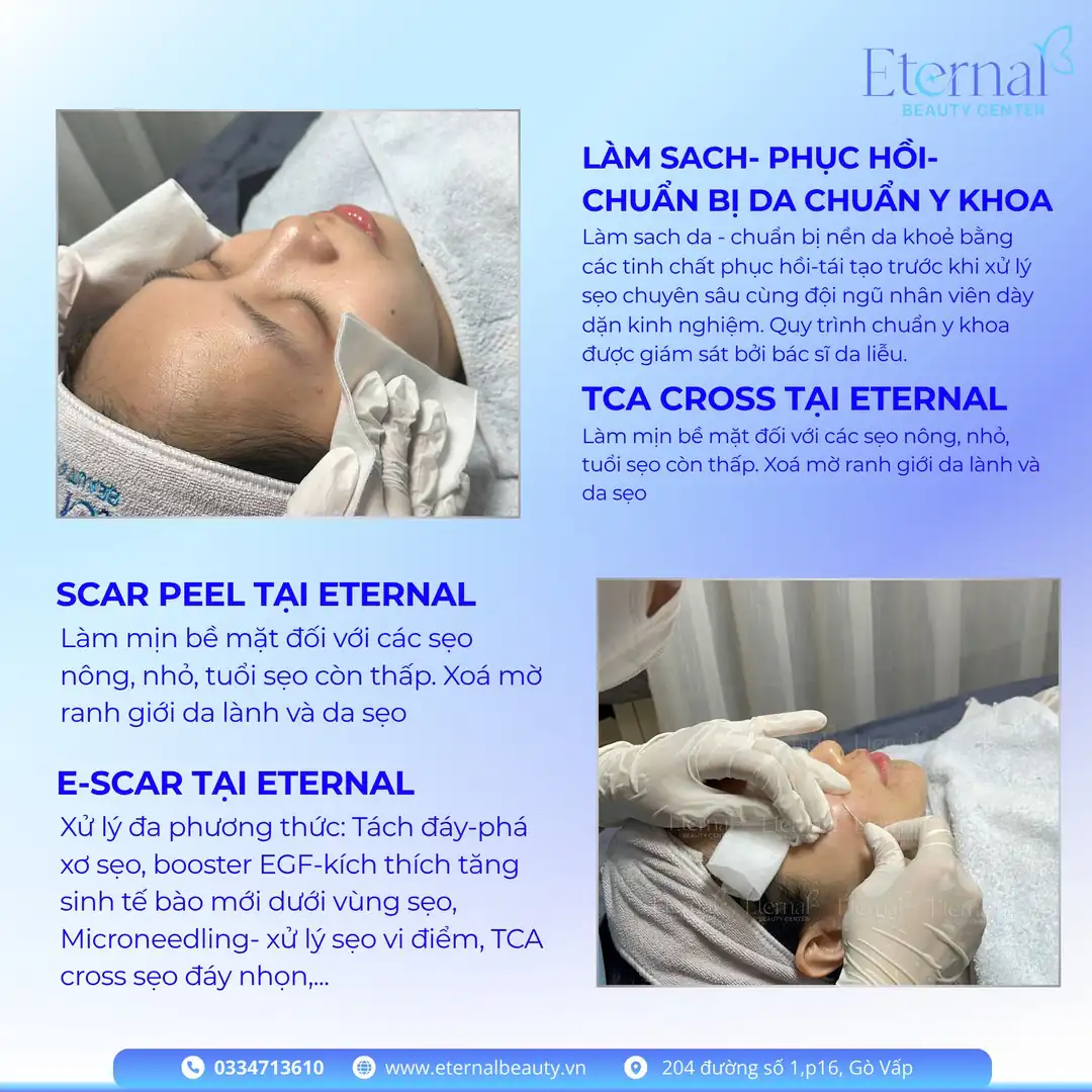 Các phương pháp xử lý sẹo rỗ tại Eternal: Làm sạch chuẩn y khoa, TCA Cross, Scar Peel, E-Scar