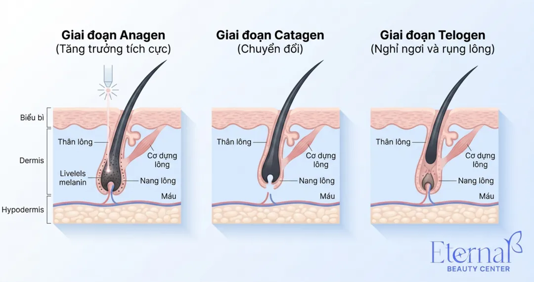 The hair growth cycle has three phases — anagen, catagen, telogen — and laser is only effective in the anagen phase