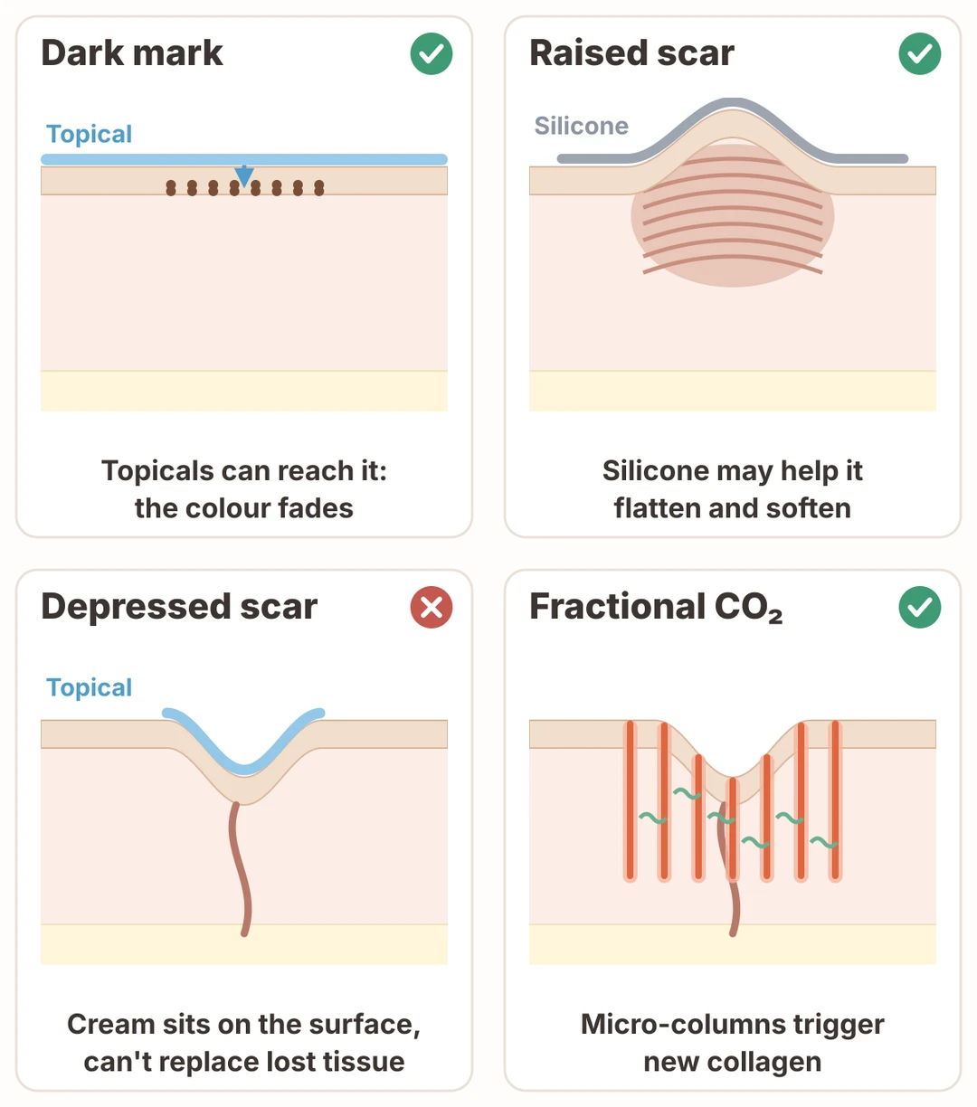 Diagram of four situations: a dark mark sits in the outer layer, so topicals can reach it; a raised scar may flatten with silicone; on a depressed scar, cream only sits on the surface and cannot replace lost tissue; fractional CO₂ laser creates micro-columns into the dermis that trigger new collagen