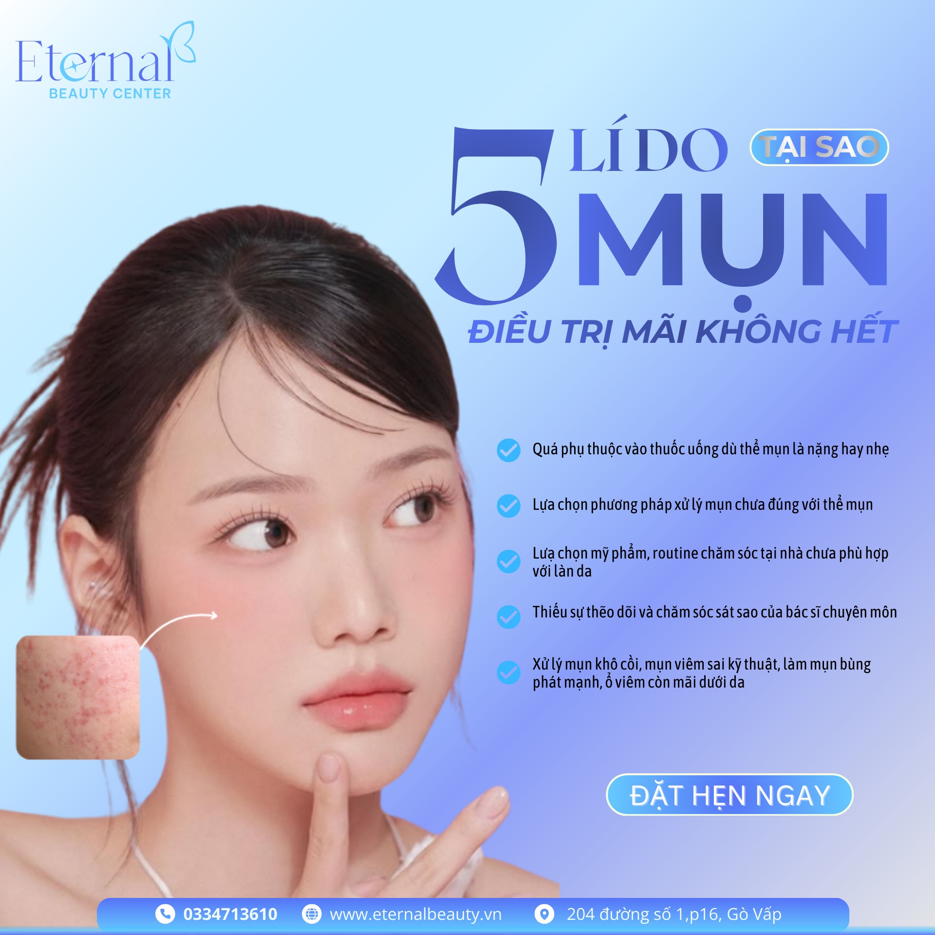 Tất Cả Những Điều Bạn Cần Biết Về Mụn