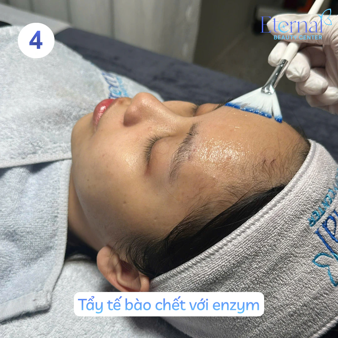 Bước 4 – Tẩy tế bào chết trong quy trình xử lý nhân mụn chuẩn y khoa tại Eternal