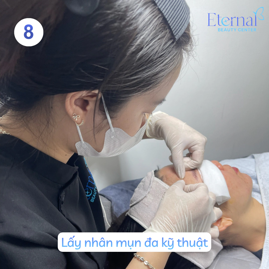 Bước 8 – Lấy nhân mụn trong quy trình xử lý nhân mụn chuẩn y khoa tại Eternal