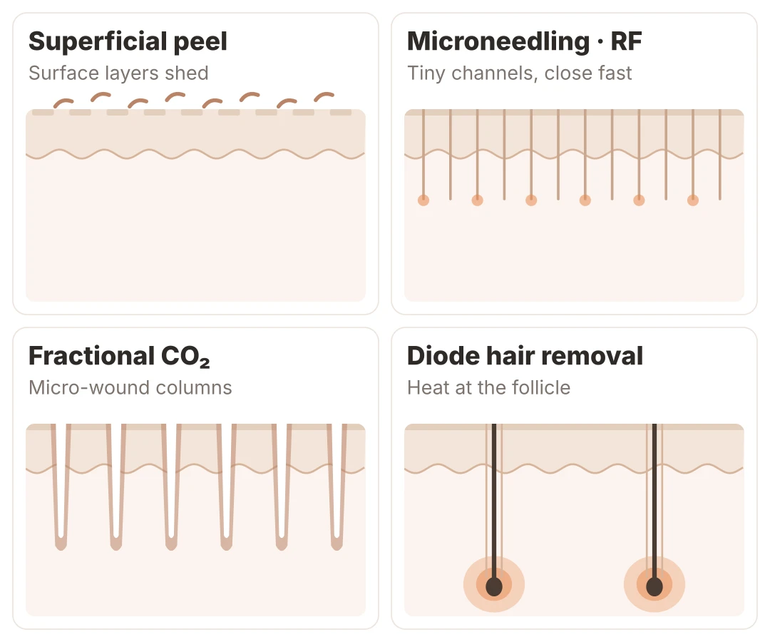 Diagram of four kinds of injury: a superficial peel sheds the surface layers, microneedling and RF microneedling make small channels that close quickly, fractional CO₂ laser creates columns of micro-wounds into the dermis, and diode hair removal concentrates heat in the follicle while sparing the outer skin