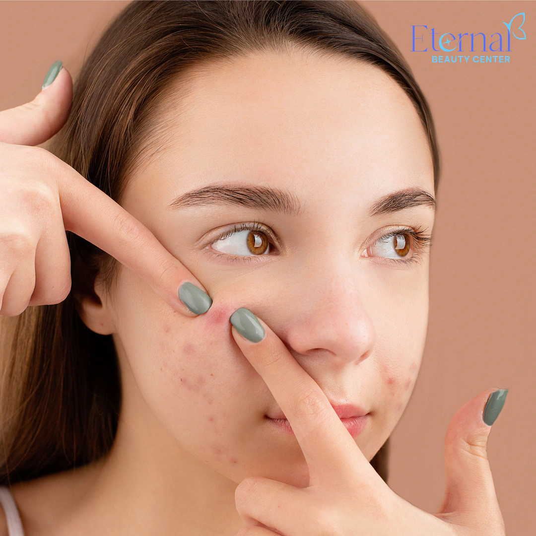 Do Closed Comedones (Hidden Acne) Go Away on Their Own? An Expert Guide