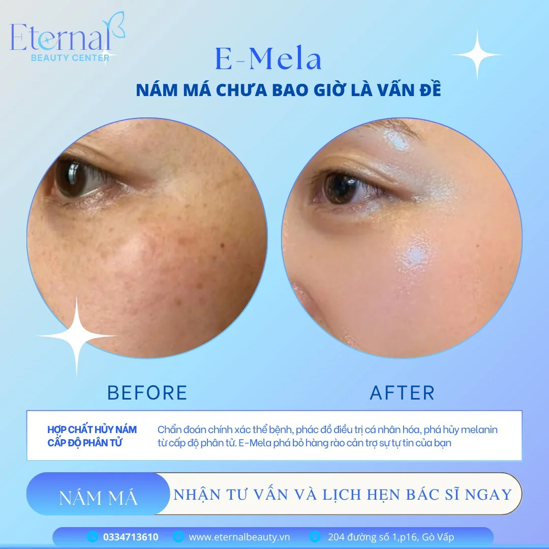Hình ảnh trước và sau liệu trình E-Mela trị nám má tại Eternal Beauty Center