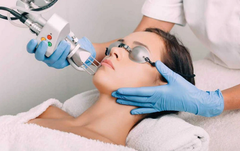 Illustration of a fractional CO₂ laser treatment: the handpiece is held close to the cheek, the person treated wears protective eye shields and the operator wears gloves