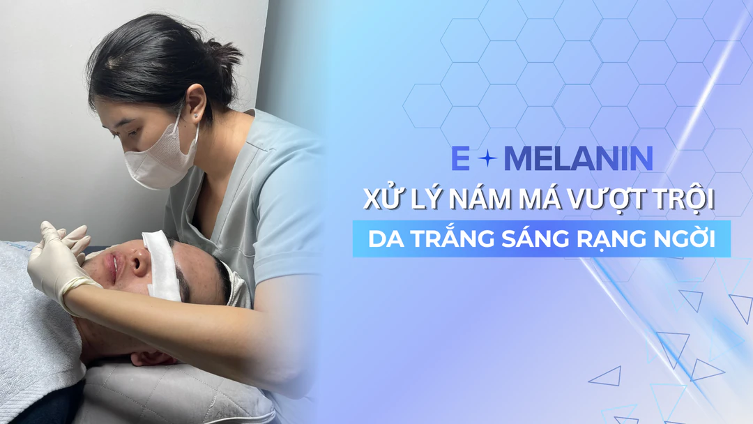 E-Mela – Intensive Treatment for Resistant Cheek Melasma in Go Vap