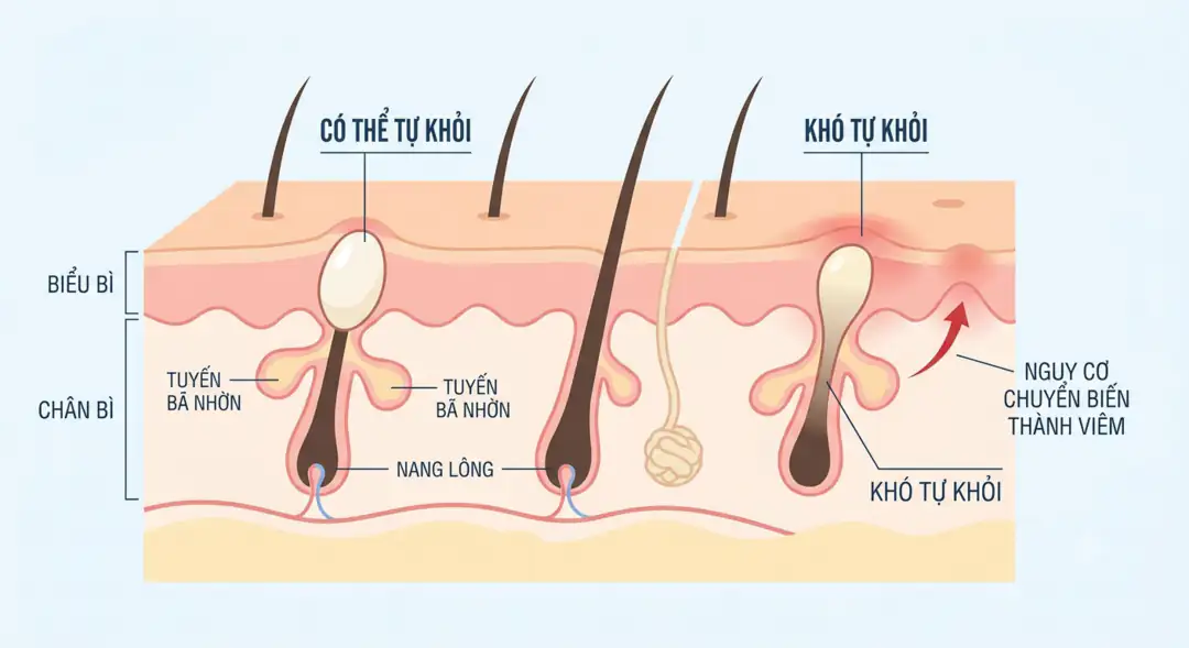 Sơ đồ mụn ẩn nằm nông có thể tự khỏi và nằm sâu khó tự khỏi