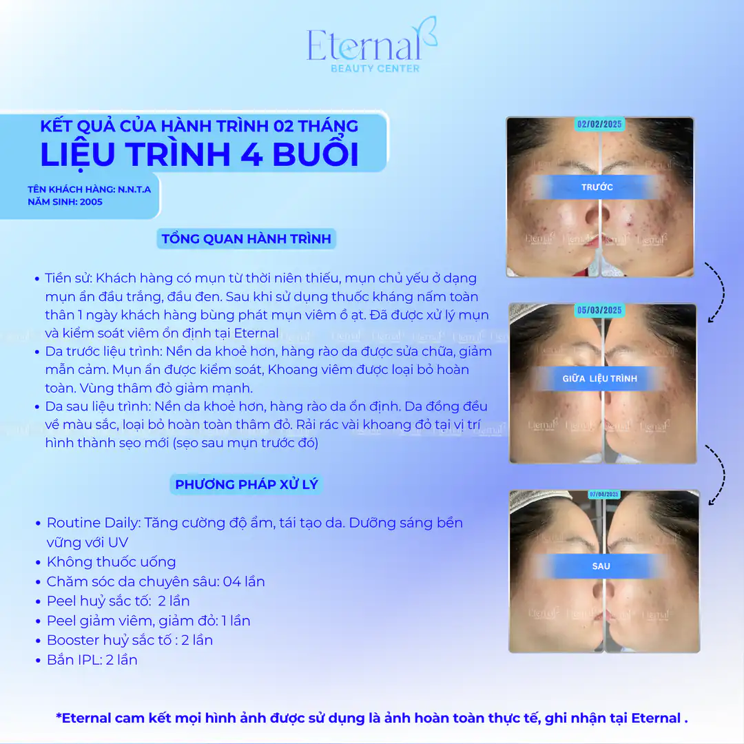 Hành Trình Cải Thiện Mụn, Thâm Và Sẹo Rỗ Tại Eternal Beauty Center: Những Hồ Sơ Điều Trị Thực Tế