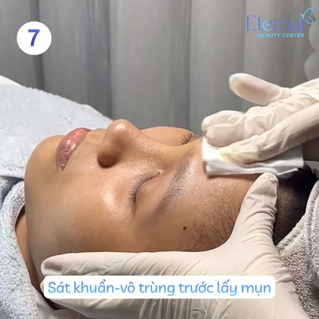 Bước 7 – Sát khuẩn trong quy trình xử lý nhân mụn chuẩn y khoa tại Eternal