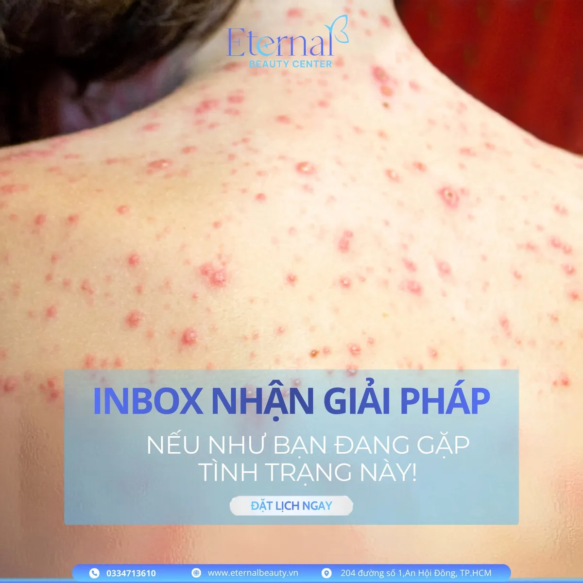 Lưng trên và vai với nhiều sẩn đỏ, mụn mủ lan rộng — khi mụn dày đặc, viêm nhiều hoặc lan nhanh, nên đi khám thay vì tiếp tục tự xử lý
