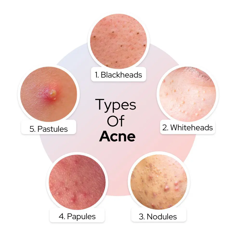 Type of Acne