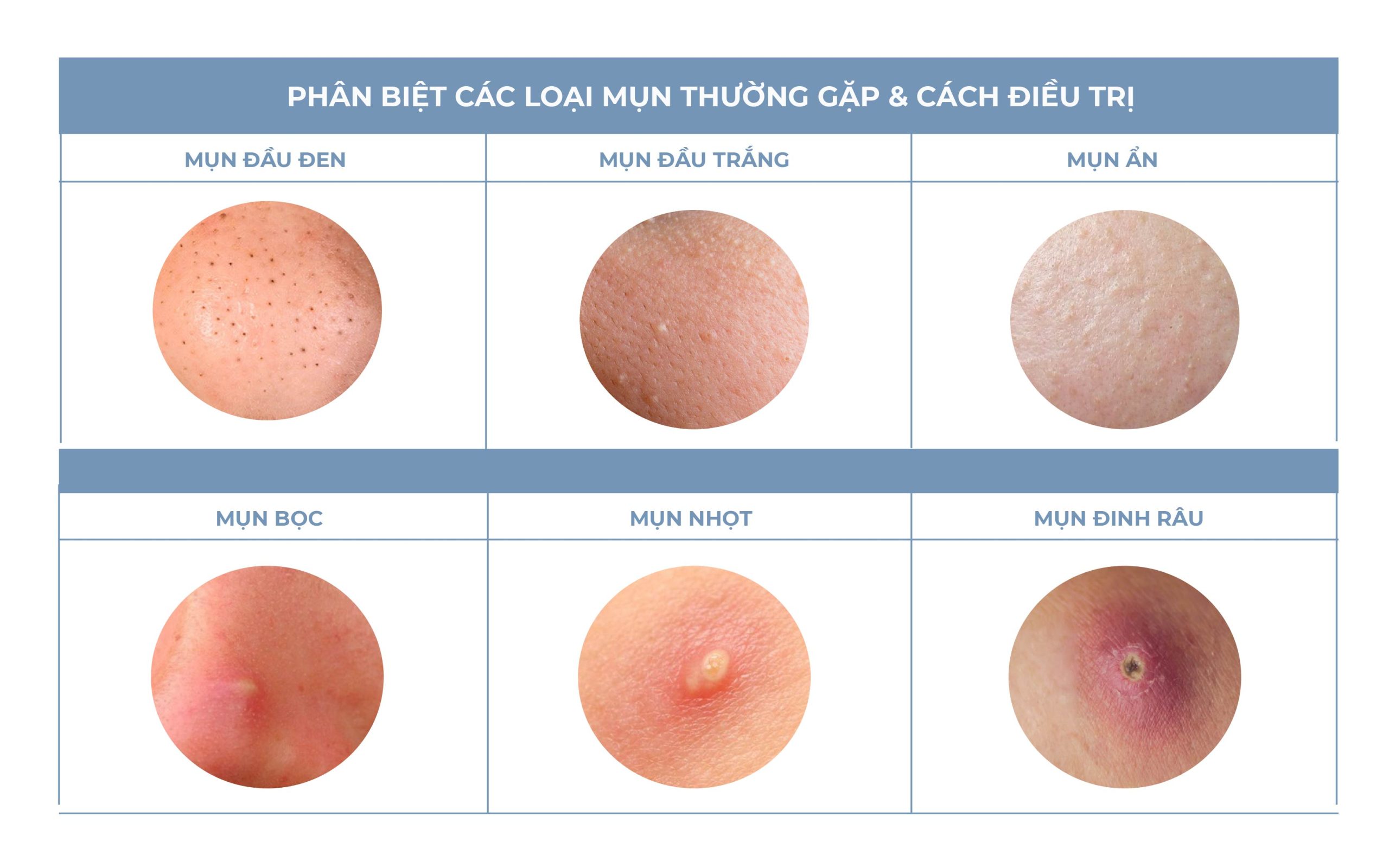 Các loại mụn