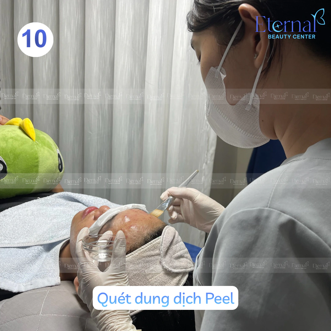 Chuyên viên quét dung dịch peel lên da khách hàng bằng cọ trong buổi peel chuẩn y khoa tại Eternal