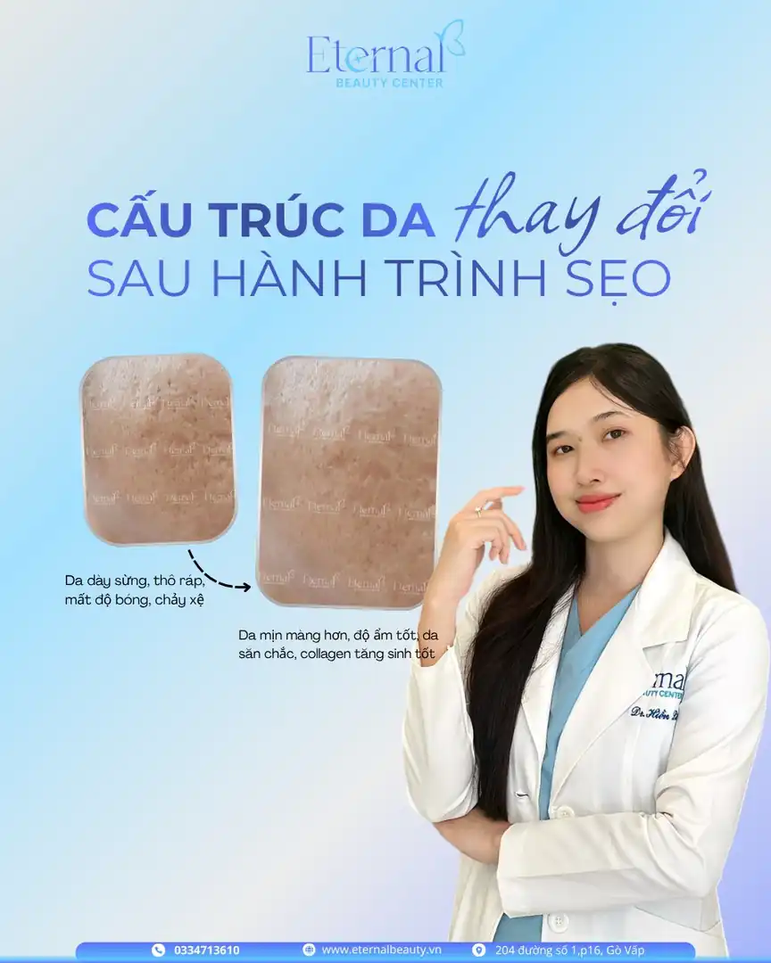 So sánh cấu trúc da trước và sau liệu trình xử lý sẹo rỗ tại Eternal