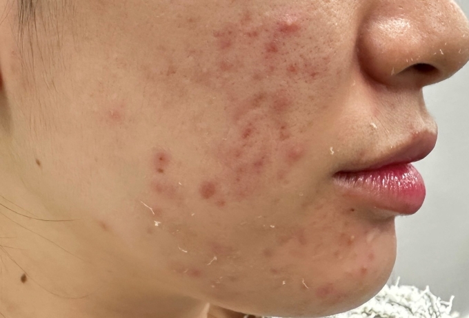 Mụn là gì?
